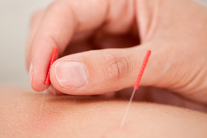 Acupuncture: To Needle…or Not to Needle?